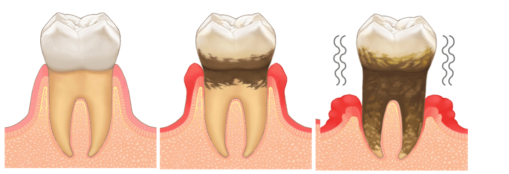 歯周病