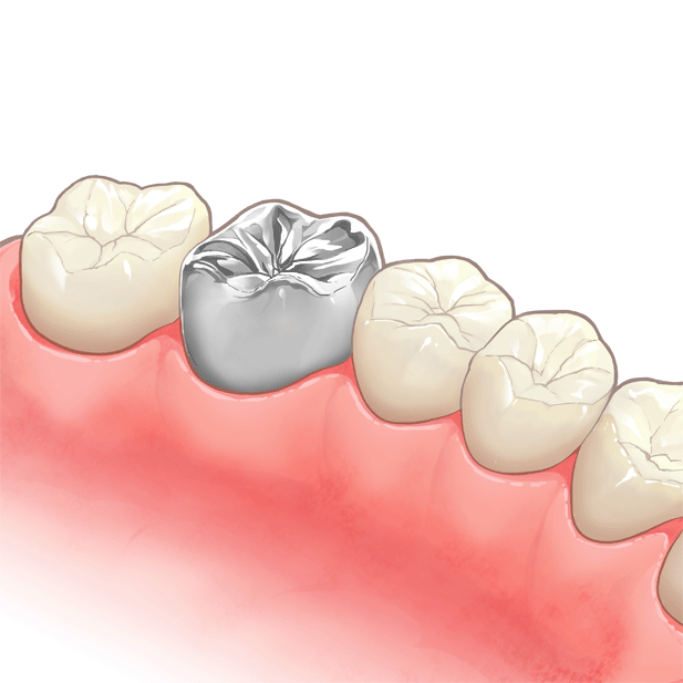 被せ物（クラウン）