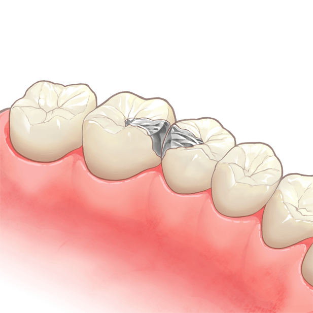 詰め物（インレー）