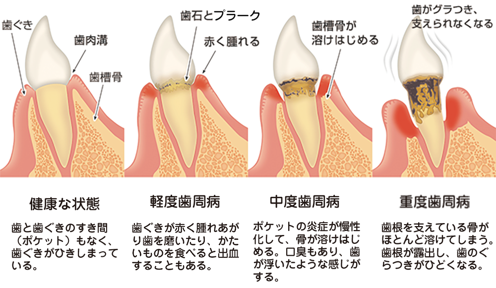 歯周病の進行